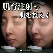 【女性・肌】肌育注射_before_aftar
