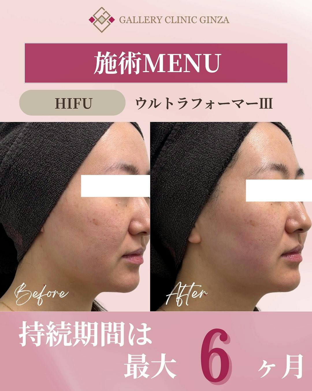 【女性・たるみ】HIFU_before_aftar