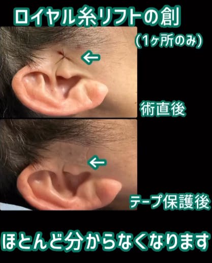 【男性・創口】ロイヤル糸リフト_before_aftar