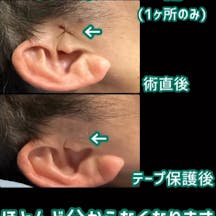 【男性・創口】ロイヤル糸リフト_before_aftar