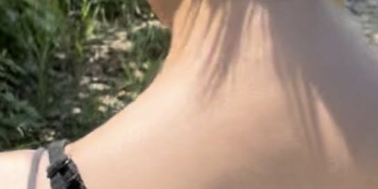 品川美容外科渋谷院(※品川スキンクリニック提携)で肩ボトックス注射・ボトックス注射・韓国製ボトックス・ボツリヌストキシン・アラガン製ボトックスを受けたりりさんの写真