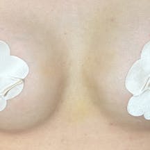 【女性・胸】Motivaエルゴノミックス2(バッグ豊胸)_after