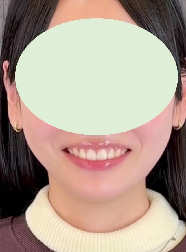 表参道スキンクリニック表参道院でガミースマイル改善：ガミースマイルボトックスを受けたnekoさんの写真