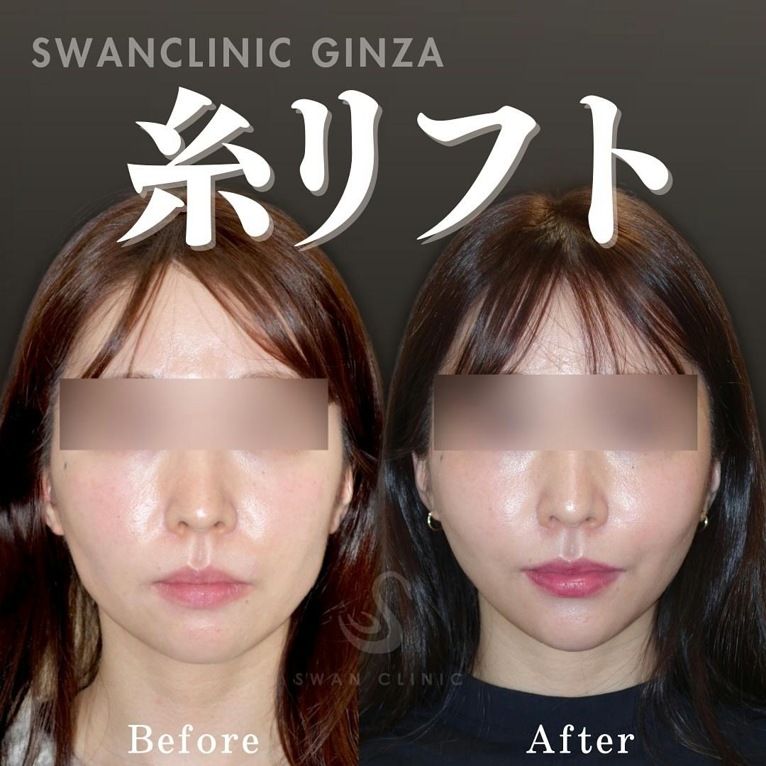 【女性・輪郭】ほうれい線とフェイスラインの糸リフト複合治療_before_aftar