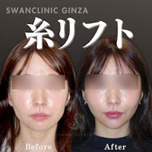 【女性・輪郭】ほうれい線とフェイスラインの糸リフト複合治療_before_aftar