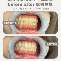 【20代女性・歯】ポリリンホワイトニング_before_aftar
