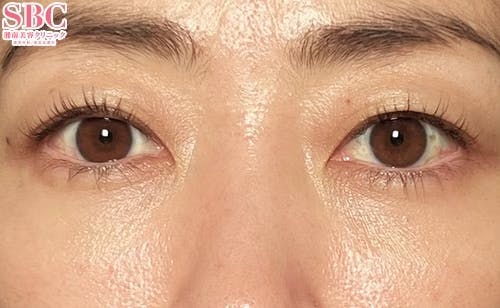 【40代女性・クマ】目の下の切らないクマ・たるみ（ふくらみ）取り、ナチュラル脂肪注射ナノリッチ、ナチュラル脂肪注射コンデンスリッチ_after