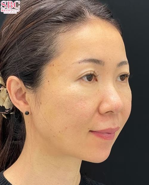 【40代女性・輪郭】シークレットリフト、VOV（ボブ）リフト、テスリフト_1week