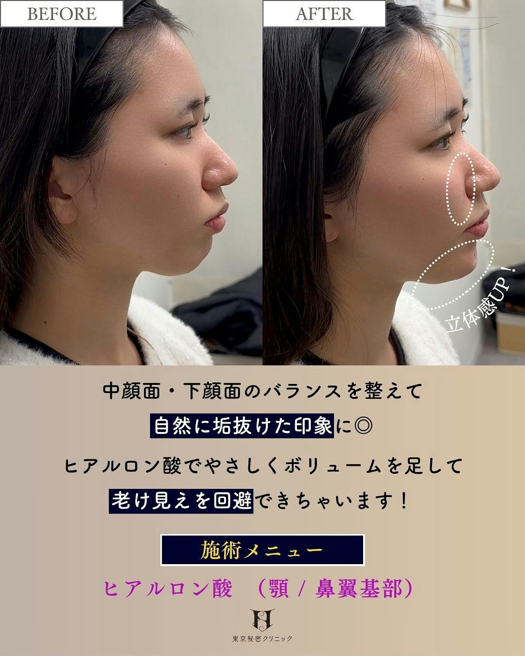【女性・輪郭】ヒアルロン酸（顎・鼻翼基部）_before_aftar