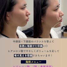【女性・輪郭】ヒアルロン酸(顎・鼻翼基部)_before_aftar