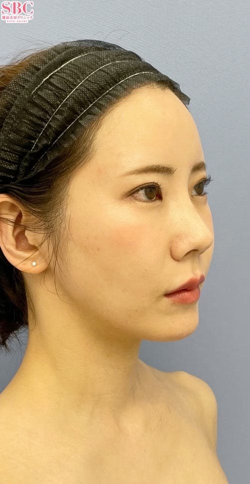 【女性・輪郭】Aquicell（アキーセル）脂肪吸引、メーラーファット除去術、根こそぎVASER脂肪吸引_aftar