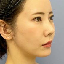 【女性・輪郭】Aquicell(アキーセル)脂肪吸引、メーラーファット除去術、根こそぎVASER脂肪吸引_aftar