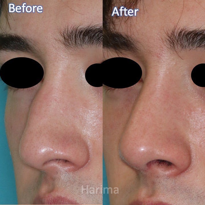 【男性・鼻】鼻形成_before_aftar