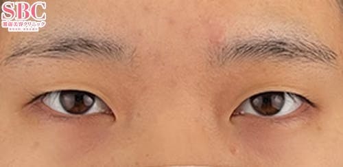 【20代女性・目元】線留めクロス二重術_before
