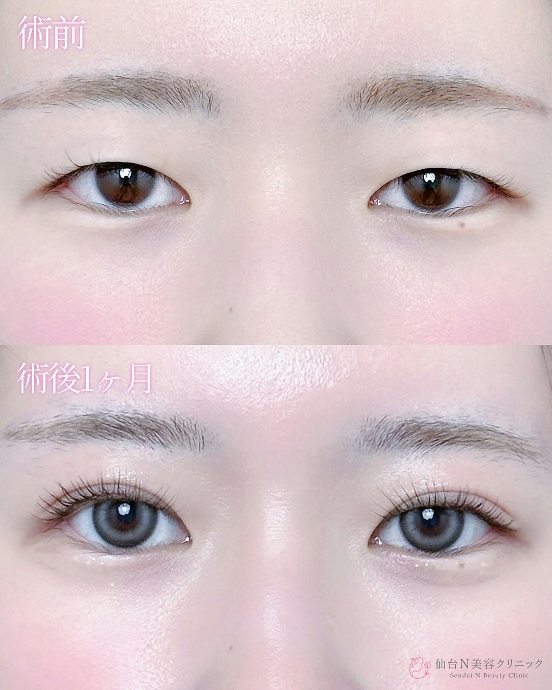 【女性・目元】二重埋没法（シークレットトリプル）_before_aftar