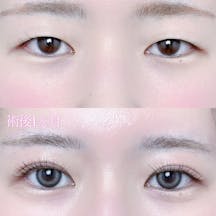 【女性・目元】二重埋没法(シークレットトリプル)_before_aftar