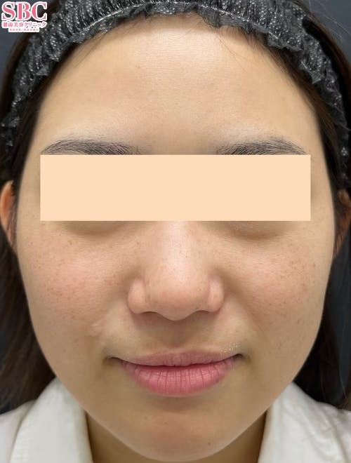 【女性・顔】フォトRF、ケミカルピーリング、エレクトロポレーション(イオン導入)_before