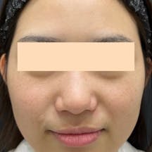 【女性・顔】フォトRF、ケミカルピーリング、エレクトロポレーション(イオン導入)_before