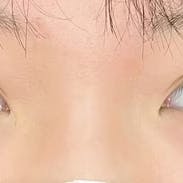 【20代女性・目元】クイックコスメティーク・ダブルNeo、自然癒着セット(上眼瞼脱脂)_after