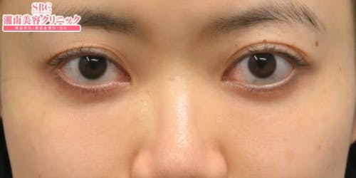 【30女性・目元】目の下の切らないクマ・たるみ（ふくらみ）取り ナチュラル脂肪注射コンデンスリッチ ナチュラル脂肪注射ナノリッチ_after