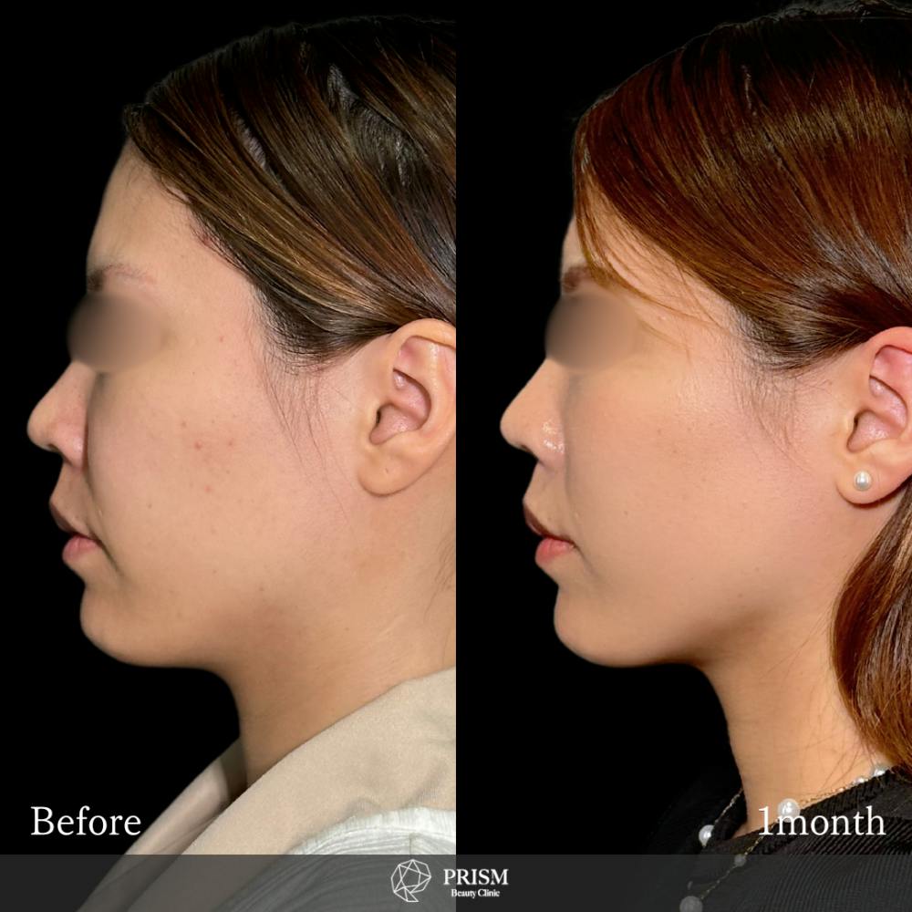 【30代女性・顔】ナゾラビアルファット除去 ＋中顔面バックリフト（ 糸リフト）_before_aftar