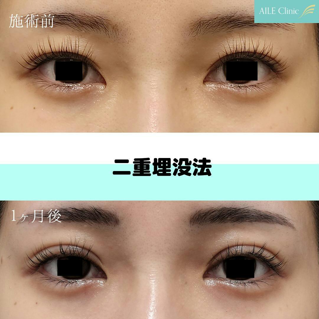 【女性・目元】二重埋没法_before_aftar