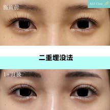 【女性・目元】二重埋没法_before_aftar