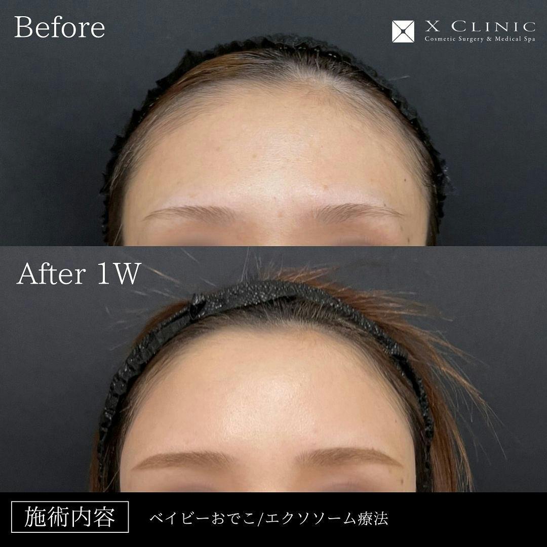 【女性・額】ベイビーおでこ＋エクソソーム_before_aftar