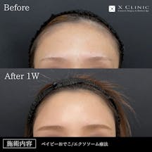 【女性・額】ベイビーおでこ+エクソソーム_before_aftar