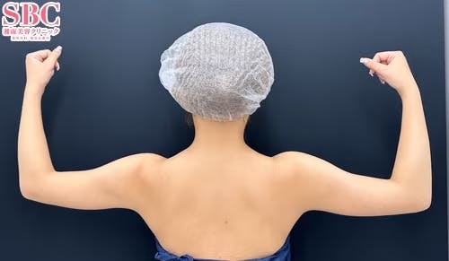 【女性・二の腕】Aquicell(アキーセル)脂肪吸引・エンブレイスRF・根こそぎVASER脂肪吸引_before