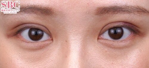 【20代女性・目元】クイックコスメティーク・トリプルNeo_1week