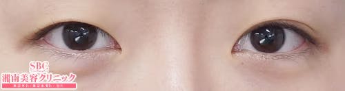 【女性・目元】クイックコスメティーク・シングルNeo、クイックコスメティーク・ダブルNeo、埋没法二重術クイックコスメティーク法_before