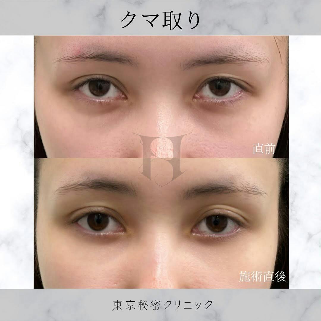 【女性・目元】クマ取り_before_aftar