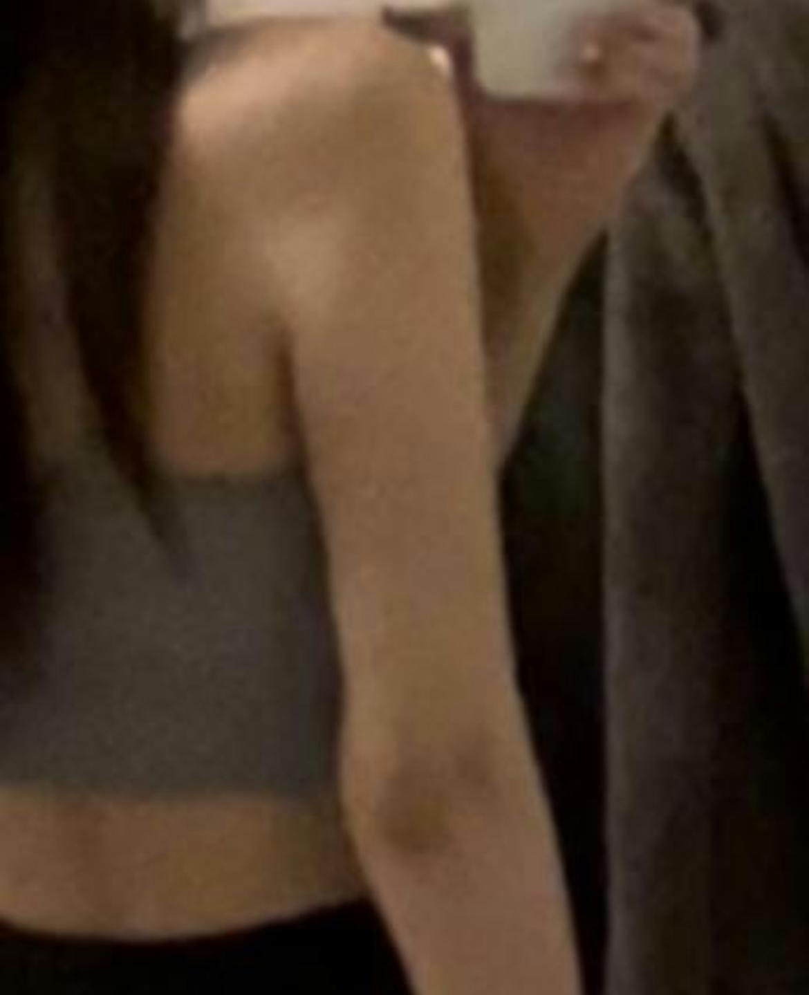湘南美容クリニック 銀座院で二の腕肩脂肪吸引を受けたひのさんの写真