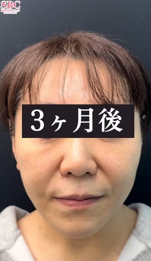 【60代女性・小顔】美ボディ脂肪吸引、その他の治療法_aftar