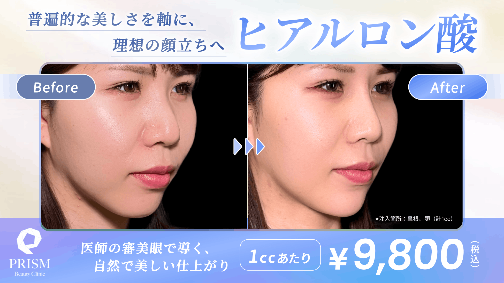 ヒアルロン酸注射