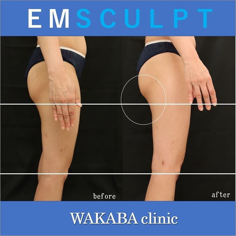 【40代女性・臀部】EMSUCULPT_before_aftar
