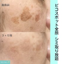 【シミ】ピコスポット全顔_before_aftar