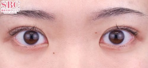 【20代女性・目元】クイックコスメティーク・トリプルNeo_1week