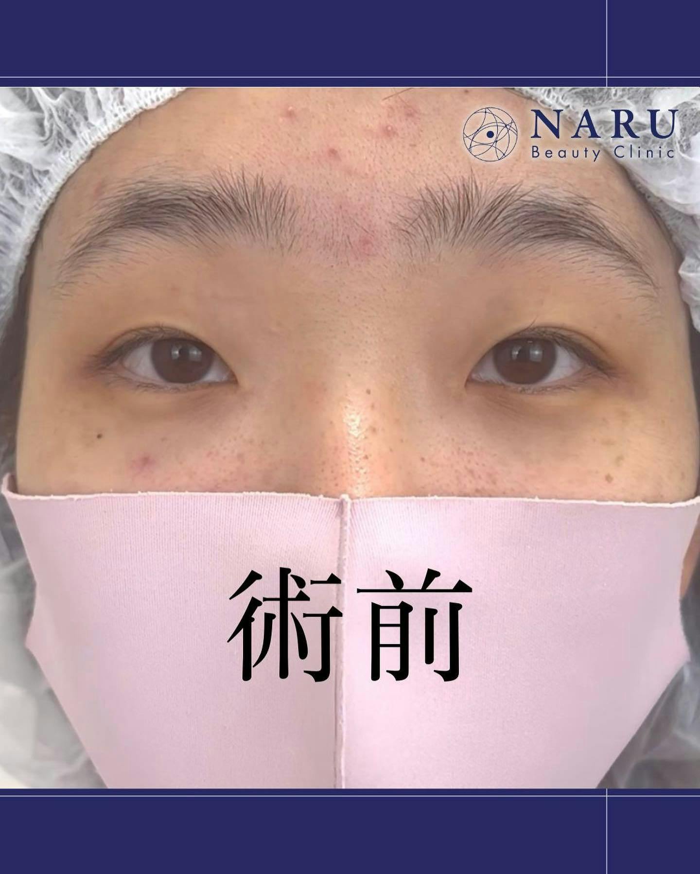 【女性・目元】二重埋没法_before