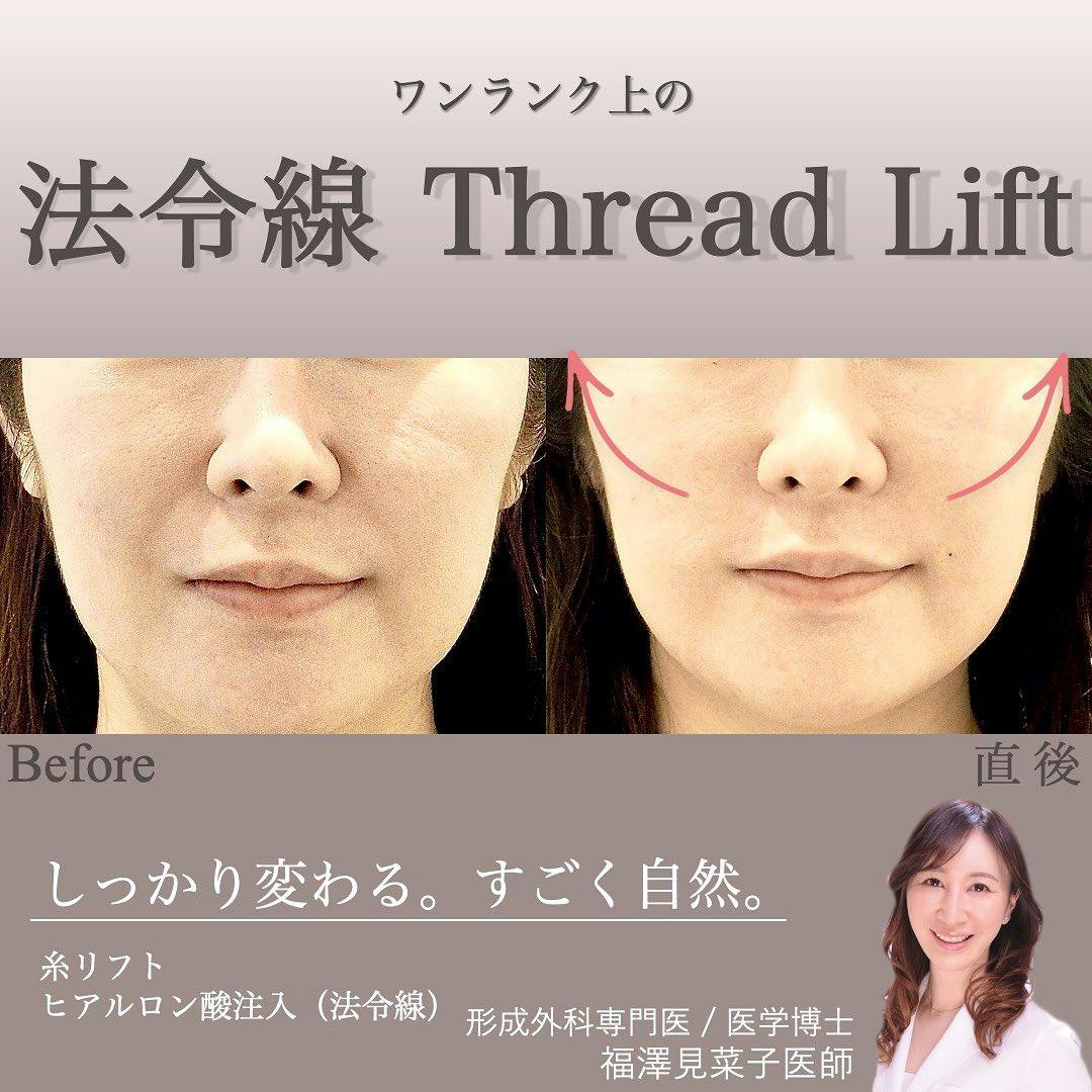 【女性・法令線】クイックリフト、ヒアルロン酸（法令線）_before_aftar