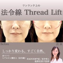 【女性・法令線】クイックリフト、ヒアルロン酸(法令線)_before_aftar