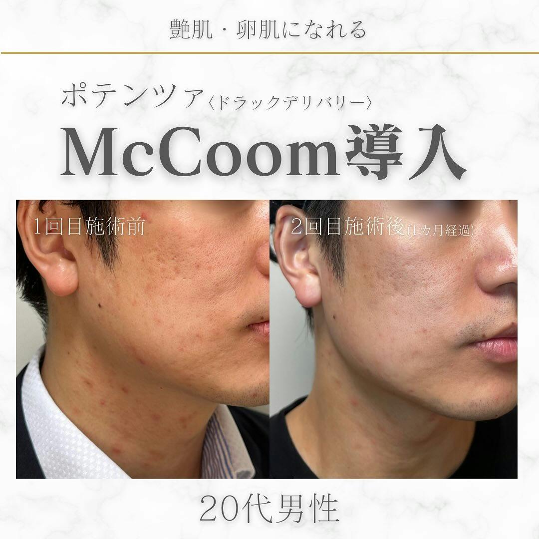 【男性20代・肌質改善】ポテンツァ McCoom導入_before_aftar