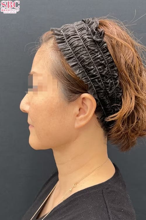 【女性・目元】Aquicell（アキーセル）脂肪吸引、根こそぎVASER脂肪吸引、エンブレイスRF、糸リフト_after