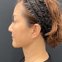 【女性・目元】Aquicell(アキーセル)脂肪吸引、根こそぎVASER脂肪吸引、エンブレイスRF、糸リフト_after