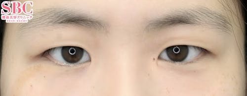 【20代女性・目元】週末二重(R)_before