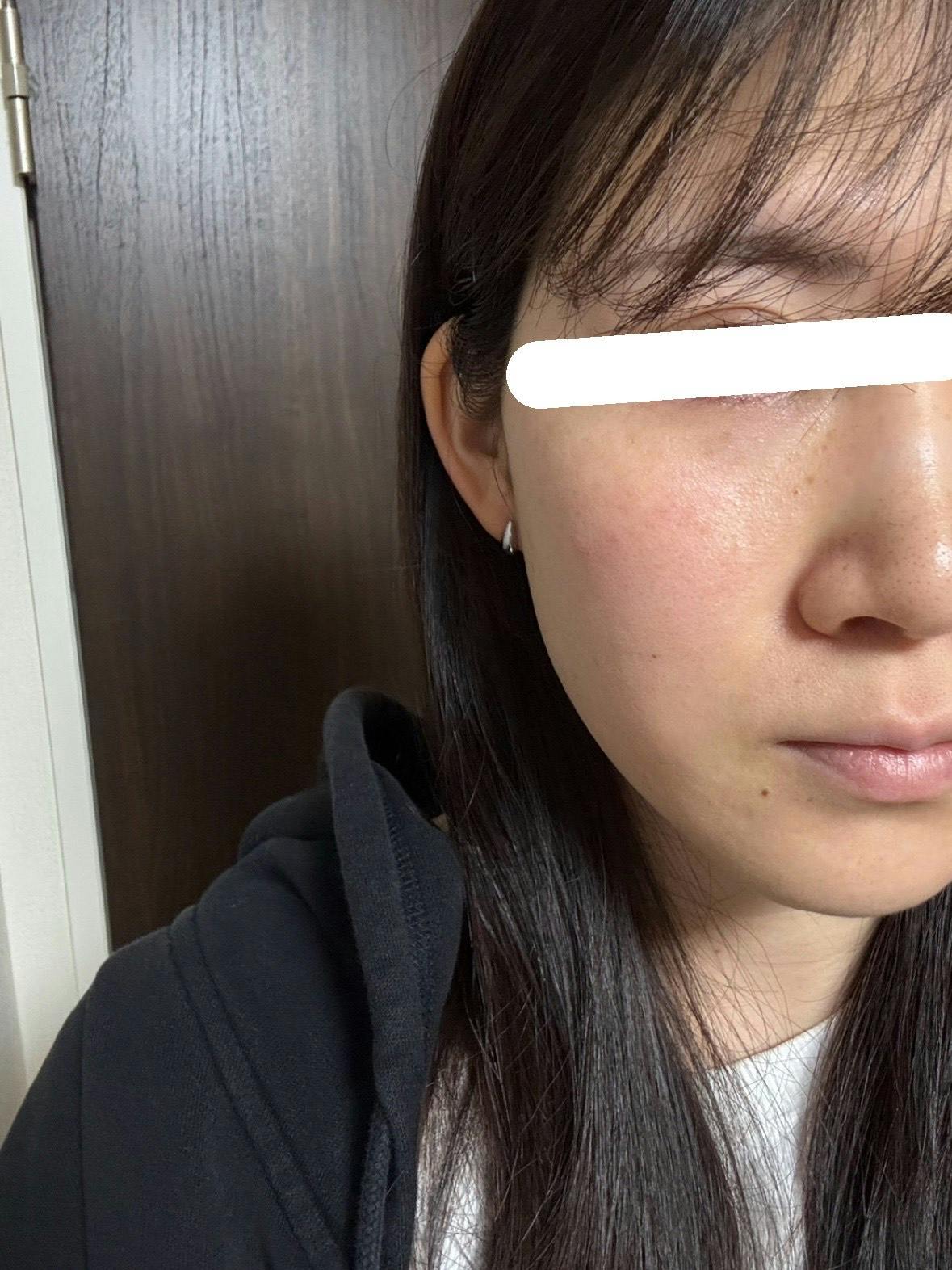 渋谷美容外科クリニック 渋谷院で目の下のクマ・たるみ取りを受けたerinaさんの写真