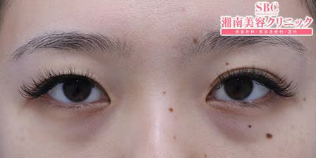 【女性・目元】週末二重(R)_before