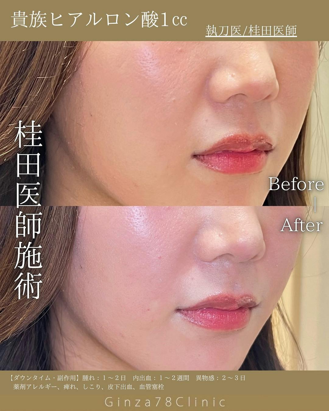 貴族ヒアルロン酸1cc_before_after