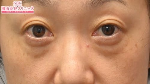 【50代女性・目元】目の下の切らないクマ・たるみ（ふくらみ）取り ナチュラル脂肪注射コンデンスリッチ ナチュラル脂肪注射ナノリッチ_before